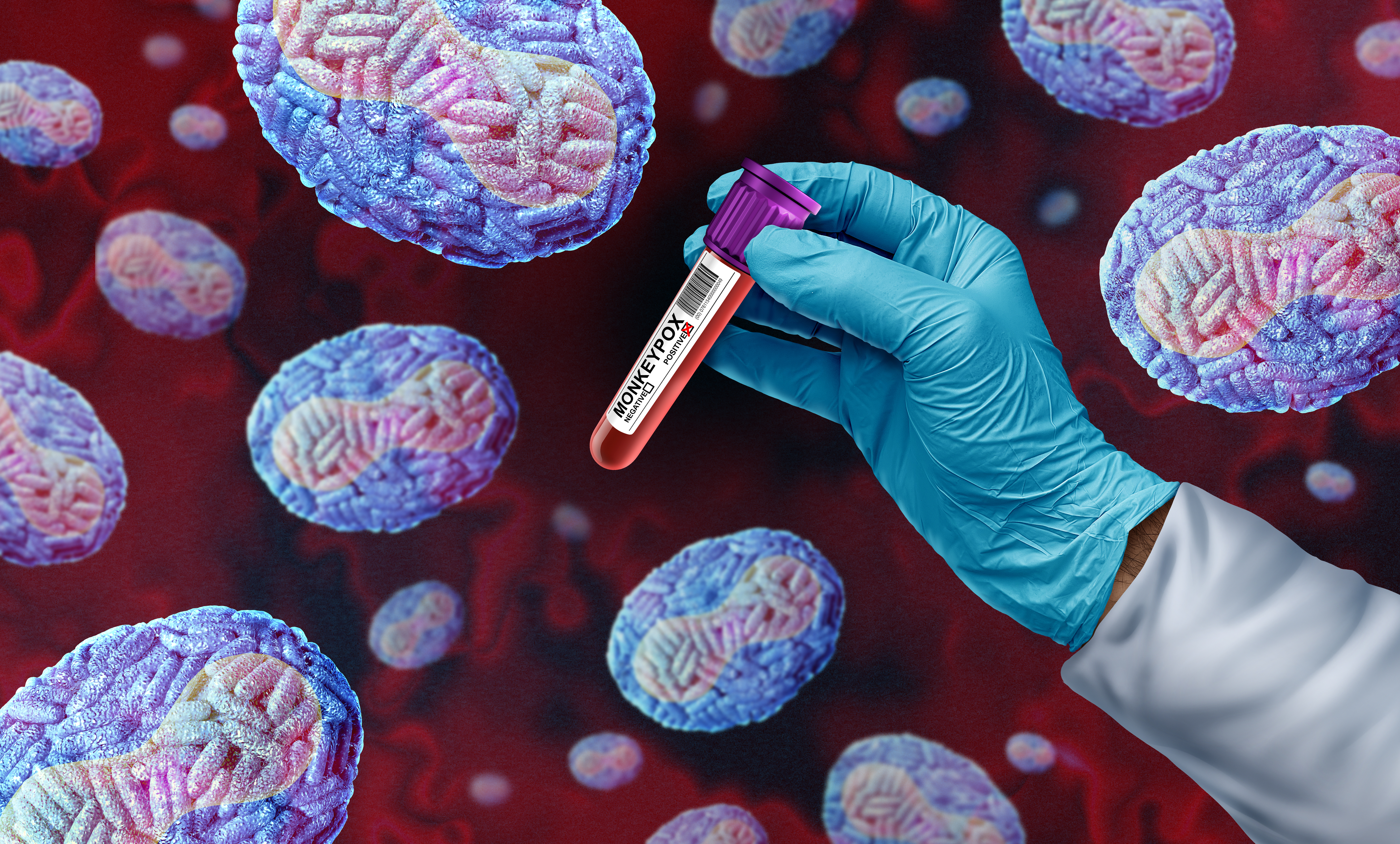 Monkeypox or Mpox Virus Outbreak disease pandemic as a doctor or scientist with infected blood with viral pathogen infecting humans as a virology science concept.