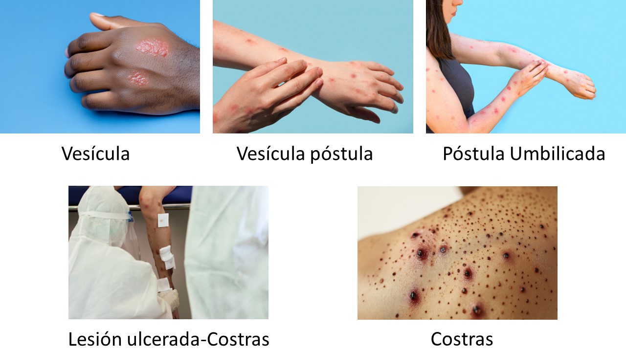 LESIONES EN LA PIEL-ETAPAS-MPOX
